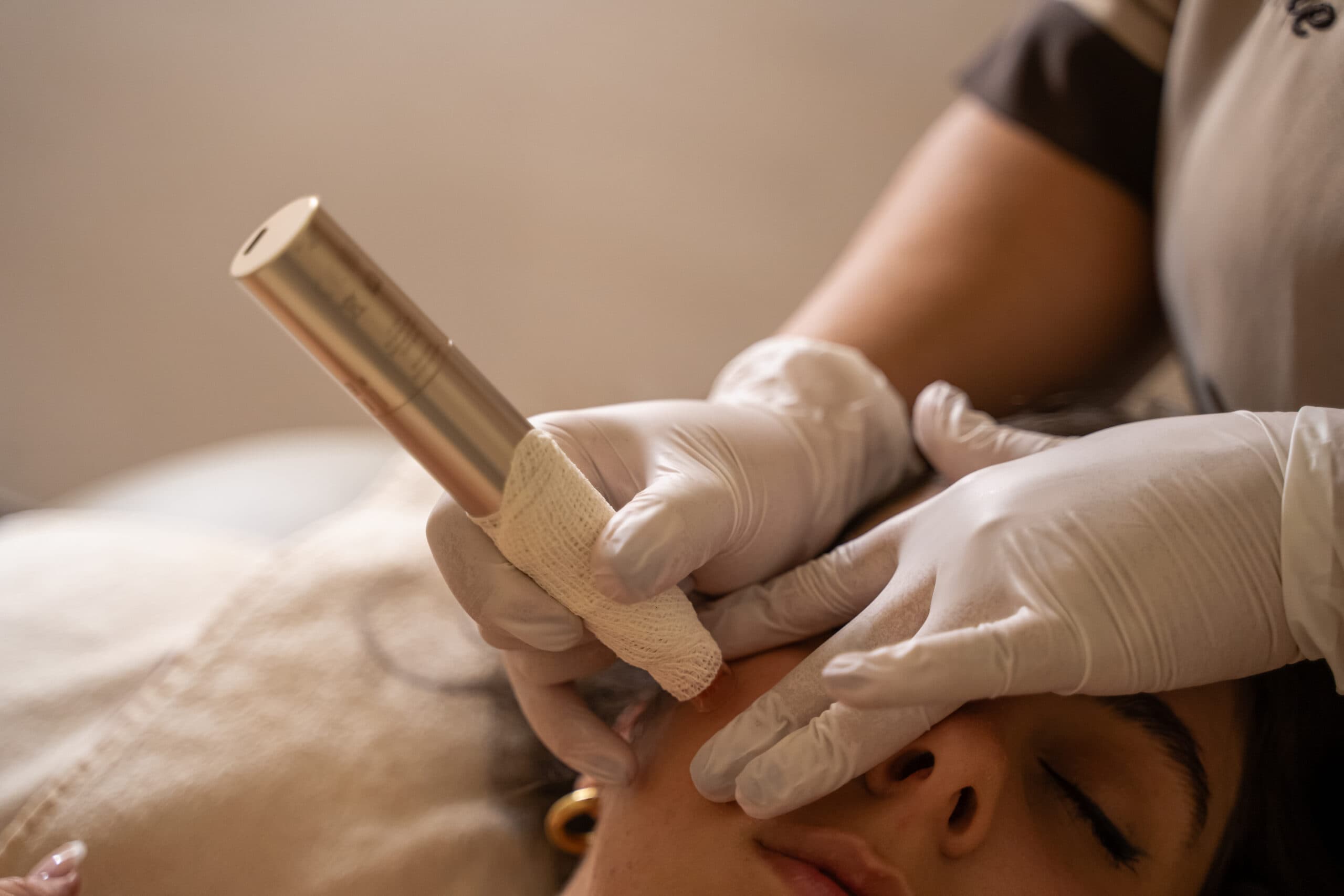 NEEDLING CORPO RIGENERANTE